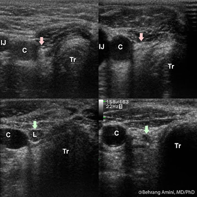 Thyroid ultrasound after thyroidectomy