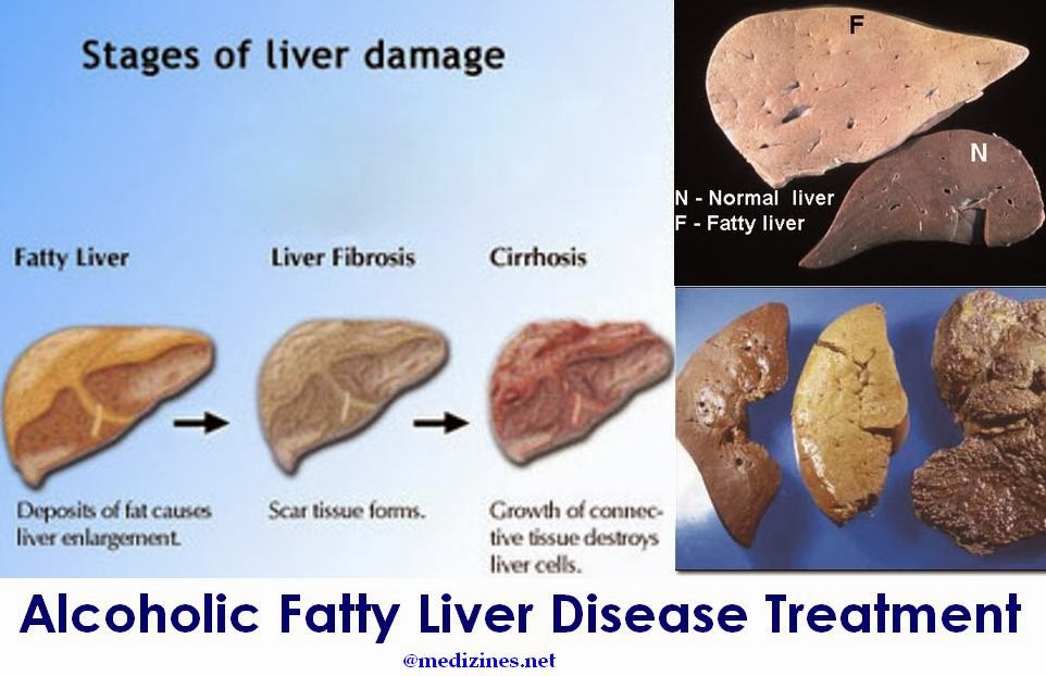 Alcoholic Liver Disease Gutcare - vrogue.co