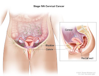 cervical-cancer-may-cure