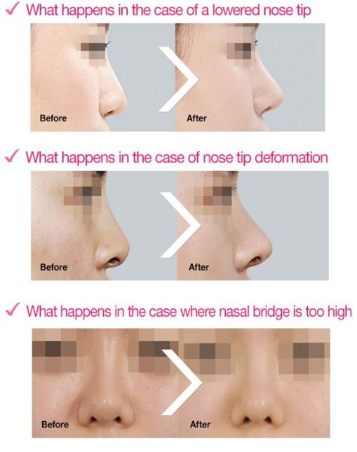 ID Hospital Korea How to get a natural nose surgery that does not