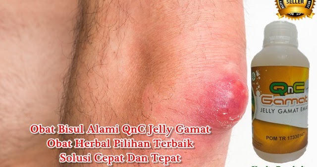 Cara Mengobati Bisul Secara Alami yang Terbukti Ampuh dan Efektif