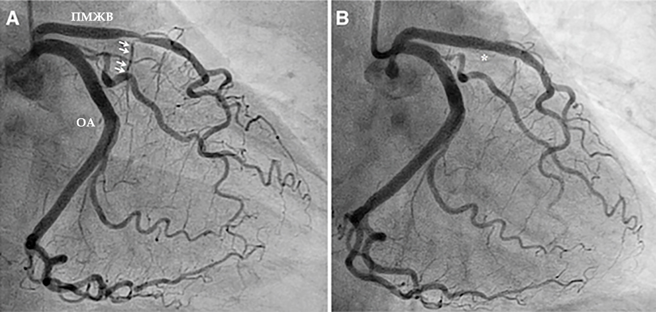 Стентирование пмжв. Стентирование пмжв. Стентирование лка пмжа это. Стентирование пмжв. Коронарные артерии сердца пмжв.
