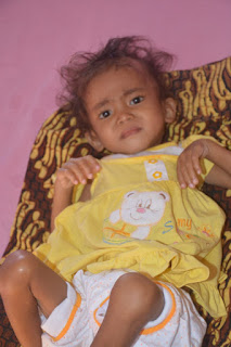 Salsabilah bocah penderita gizi buruk. Salsabilah bocah penderita gizi buruk.