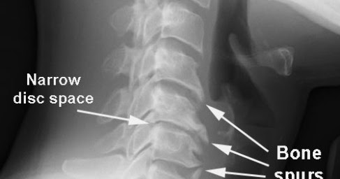 Cervical spine case study image