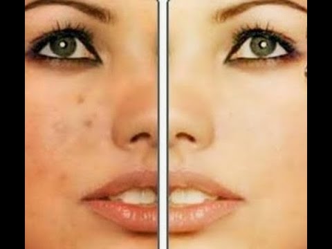 التخلص من البقع البنية في الوجه