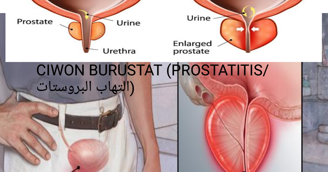 Prostatitis Kums)