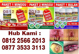 cara alami menghilangkan benjolan bengkak di lubang dubur seperti kutil tanpa operasi