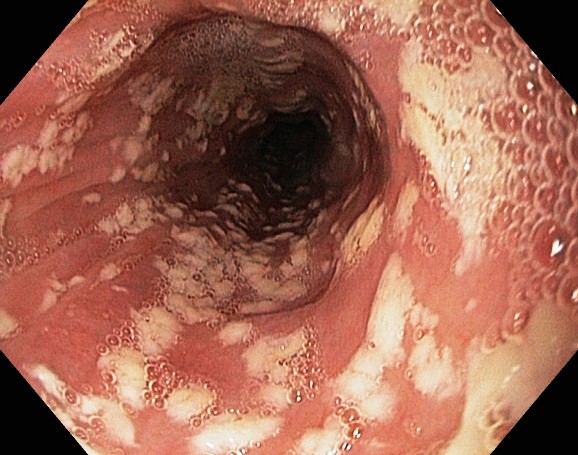 Oesophageal Candidiasis