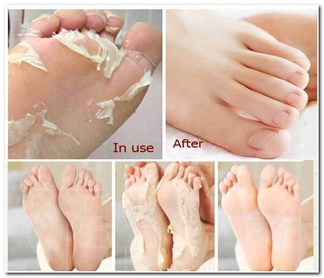 How To Take Dry Skin Off Feet SKIN PROBLEMS