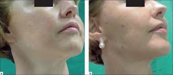 Лифтинг нефертити до и после фото