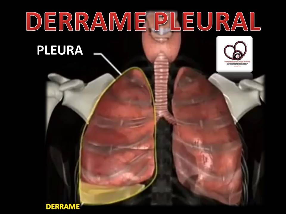 Viver Enfermagem em Cuidados Intensivos DERRAME PLEURAL