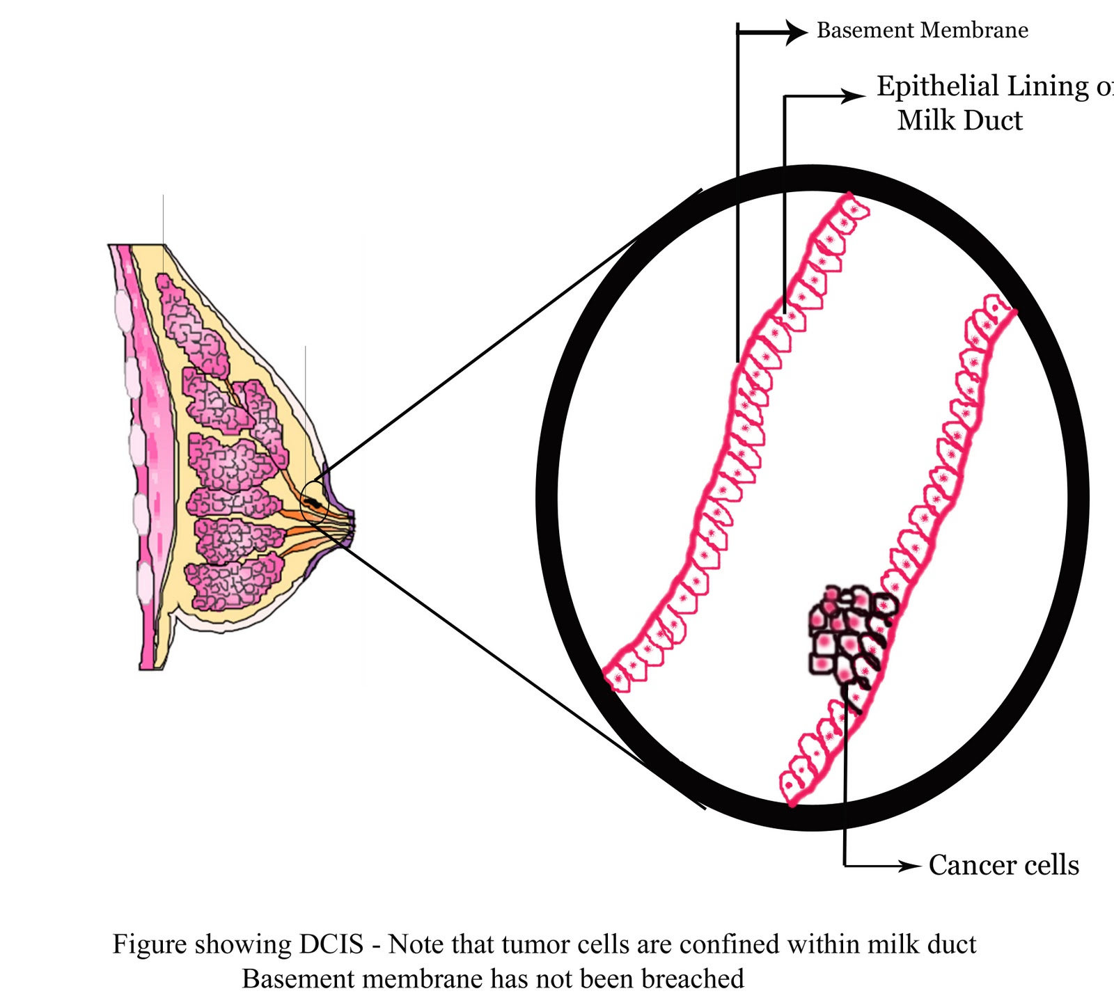 Mastectomy Mastectomy For Dcis