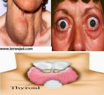 Hipertiroid