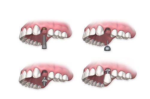 ĐÁNH GIÁ TIÊU CHUẨN CHẤT LƯỢNG XƯƠNG HÀM TRONG CẤY GHÉP IMPLANT -8