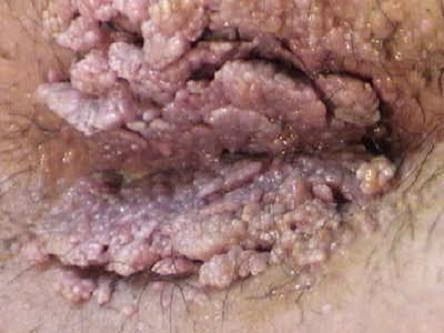 Ciri Virus Hpv