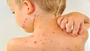 How To Eliminate Exhausted Water Pox That Has Been Removed Naturally