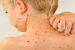 How To Eliminate Exhausted Water Pox That Has Been Removed Naturally