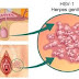 Cara Mengatasi Herpes Pada Selangkangan Dan Alat Vital 