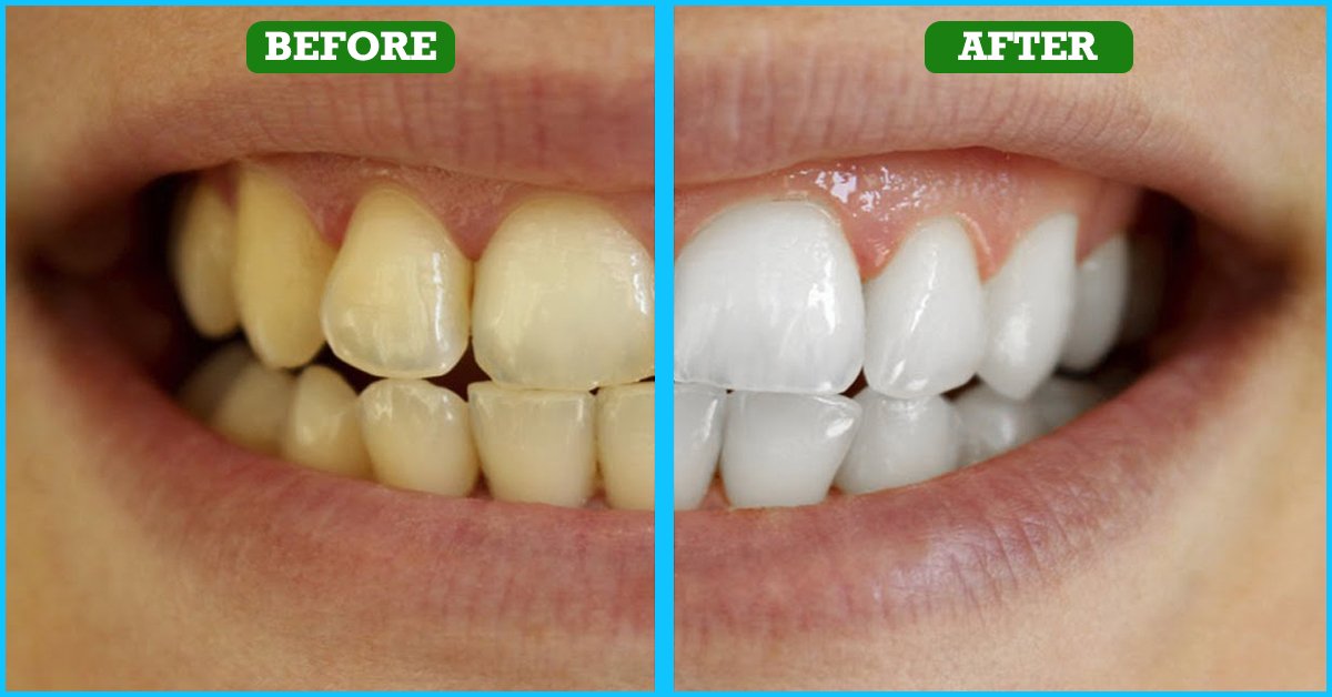 Make Your Teeth White At Home After Only 3 Minutes, A 100 Proof Of