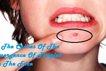 10 The Causes Of The Emergence Of Pimples On The Face