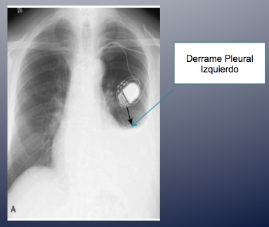 Sindrome de dressler