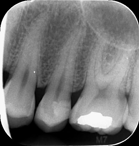 The Unnecessary Root Canal Scam Why You Should Always Get A 2nd Opinion Johnnyfd Com Follow The Journey Of A Location Independent Entrepreneur