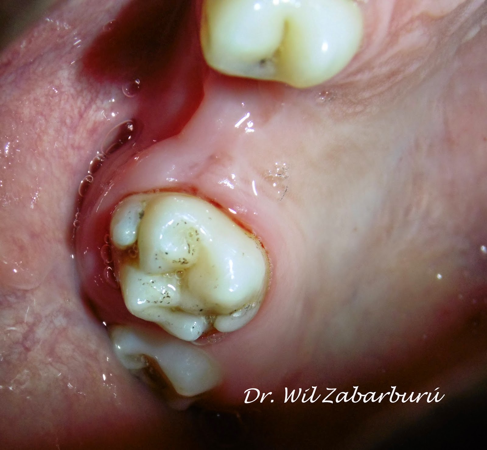 CLINICA DENTAL ASISTENCIAL TUBÉRCULO PARAMOLAR