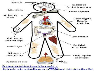 Síntomas del hipotiroidismo