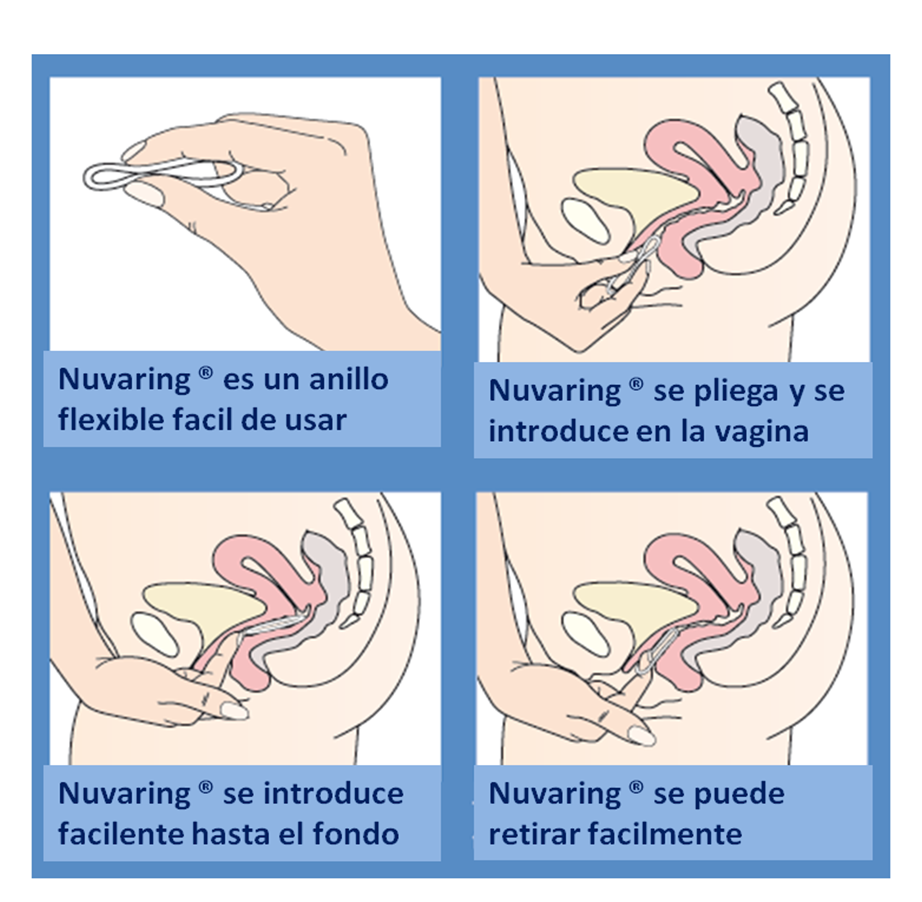 Nuvaring Quitar Anillo Anticonceptivo Nuvaring Anillo Vaginal