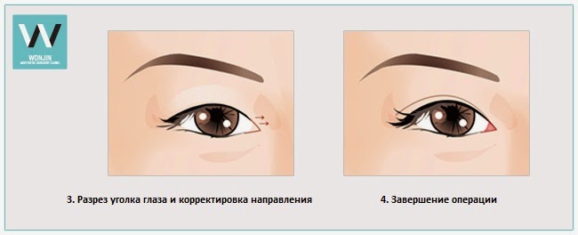 птоз ( опущение верхнего века. косоглазие причины возникновения. треугольный нос. прикрытые глаза. коньюктивит коньюктивит коньюктивит.