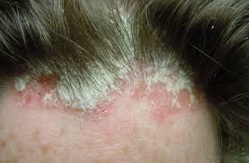 Căn bệnh vẩy nến da đầu - Phương pháp trị bệnh tốt và an toàn V%25E1%25BA%25A3y%2Bn%25E1%25BA%25BFn