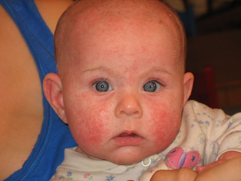 Hives in the Kitchen Healing Food Allergies