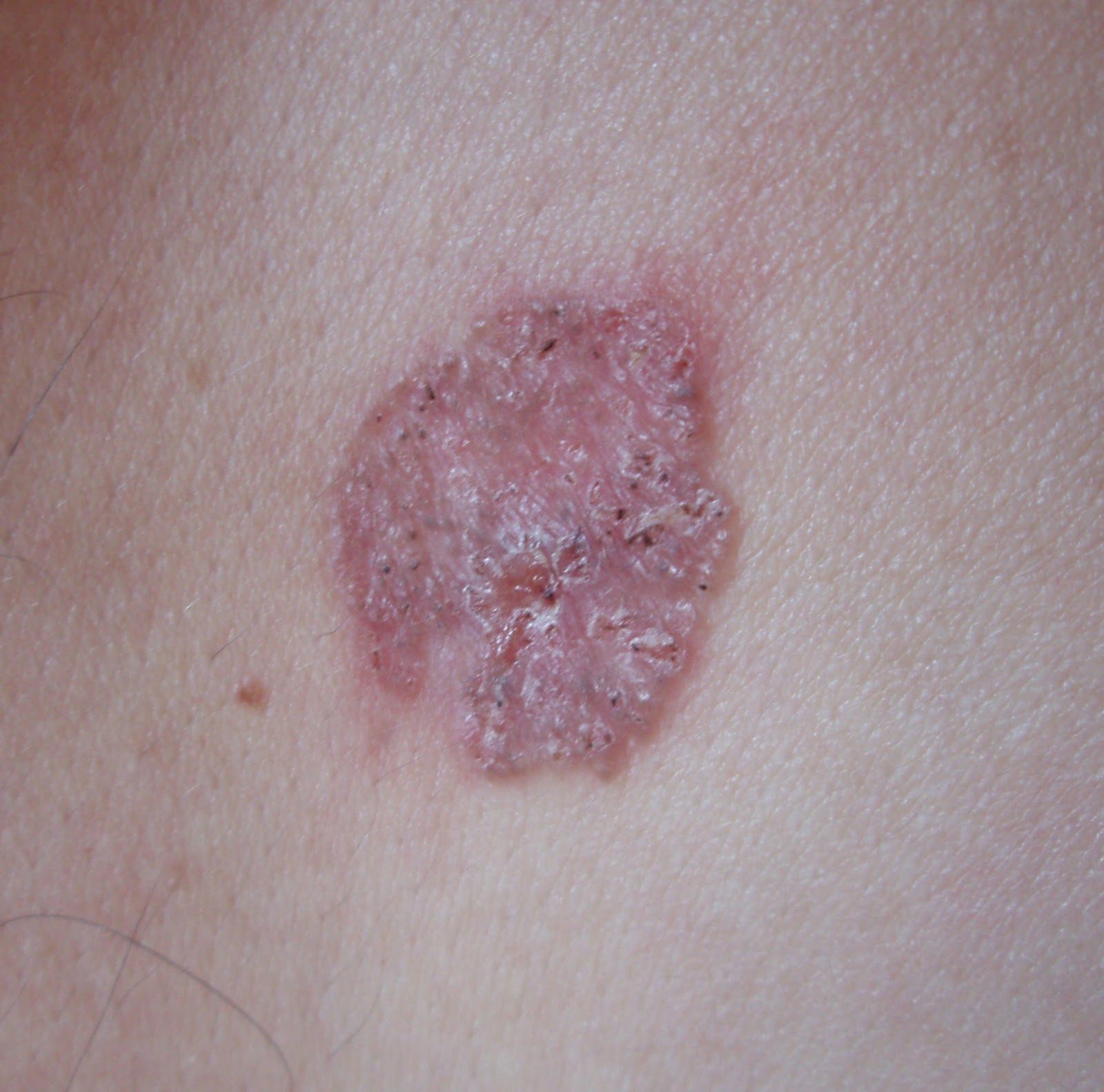 Symptoms Of Vulva Cancer: White Lumpy Skin, Warts And ...
