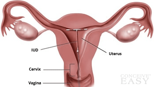 Pengertian IUD ( Intra Uterine Device ) Beserta Cara kerja dan Jenisnya Pengertian IUD ( Intra Uterine Device ) Beserta Cara kerja dan Jenisnya