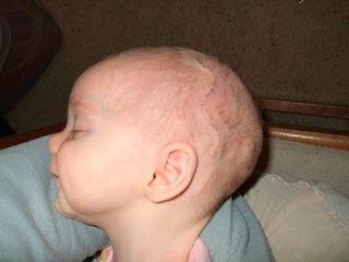 Scaphocephaly - Pictures, Symptoms, Causes, Treatment