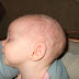 Scaphocephaly - Pictures, Symptoms, Causes, Treatment