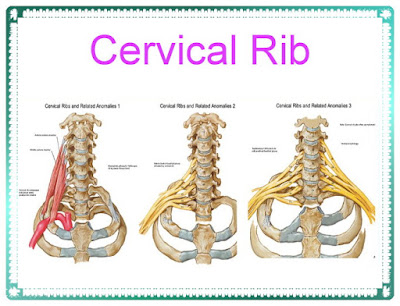 Cervical Rib