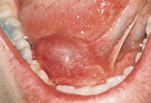 Oral Dermoid Cyst 23