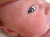 Beberapa Kondisi Bintik Merah Pada Kulit Bayi