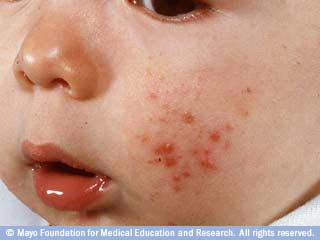 Infant, Toddler and Children, Rashes - Ask Doctor Sears