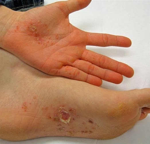 Little itchy bumps on foot? | Yahoo Answers