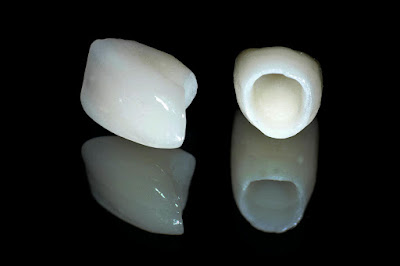 Thông tin hữu ích về bọc răng sứ Cercon