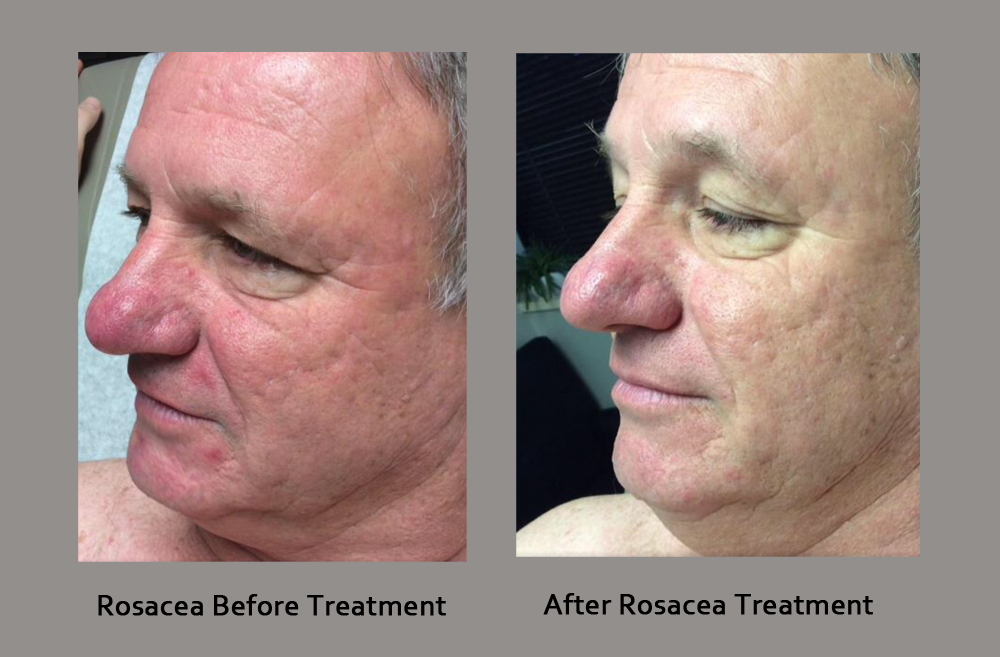 Rosacea Before And After