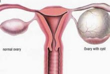 How to Eliminate Ovary Cysts With The Best Natural Remedies