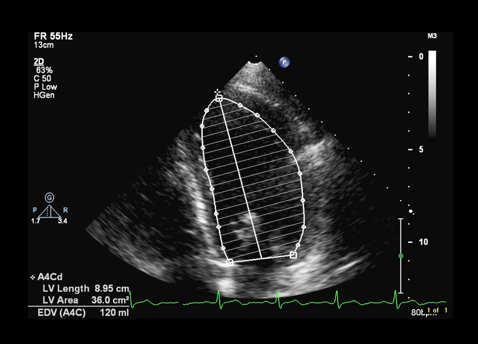 Andrew R. Houghton: Is a left ventricular ejection fraction of 50% &#39;normal&#39;?