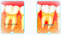 Periodontite - Implantes dentários periodontite
