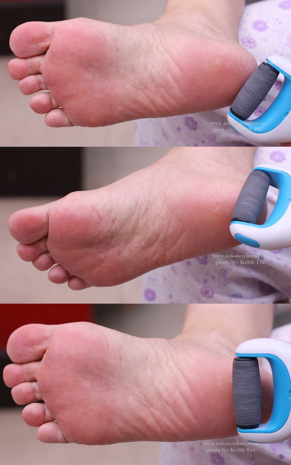 Scholl Velvet Smooth Electric Foot File Review (By a Podiatrist)