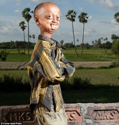 Ali Hussain Khan progeria