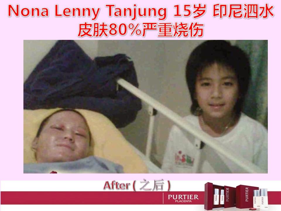 NONA LENNY TANJUNG (15) SURABAYA - 80% OF SKIN BURN