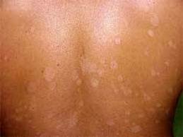  Panu ialah penyakit kulit yang di sebabkan oleh jamur Tips Cara Menghilangkan Panu Secara Alami